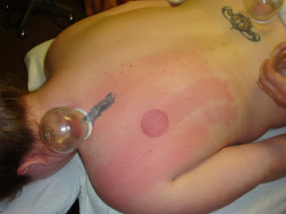 Sliding cupping